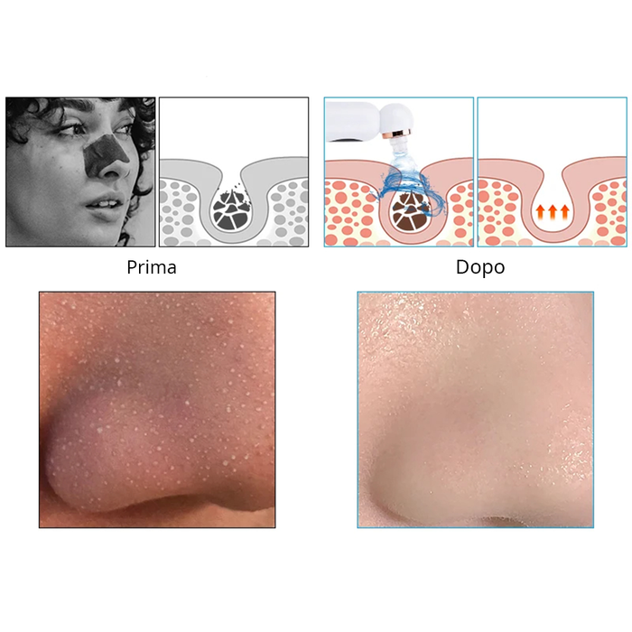 Aspiradora para imperfecciones faciales Pure Skin