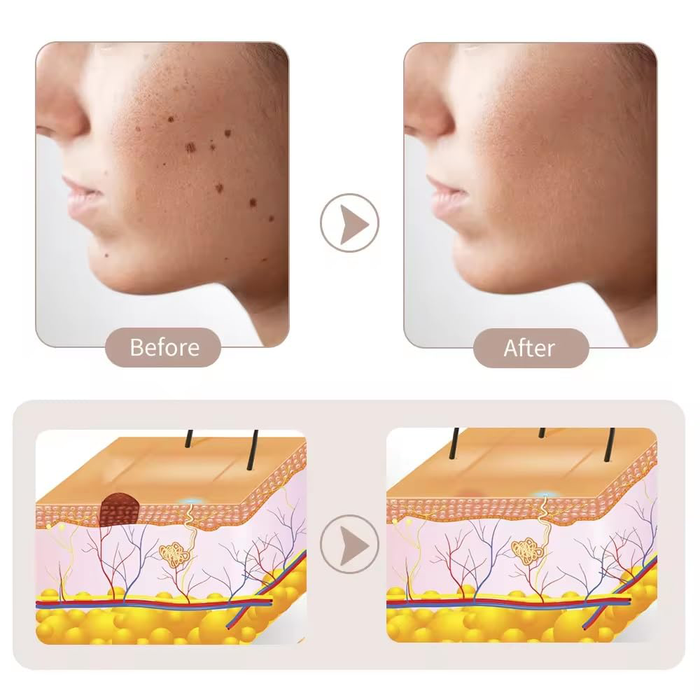 Penna Laser Plasma Rimozione Imperfezioni 15 Livelli